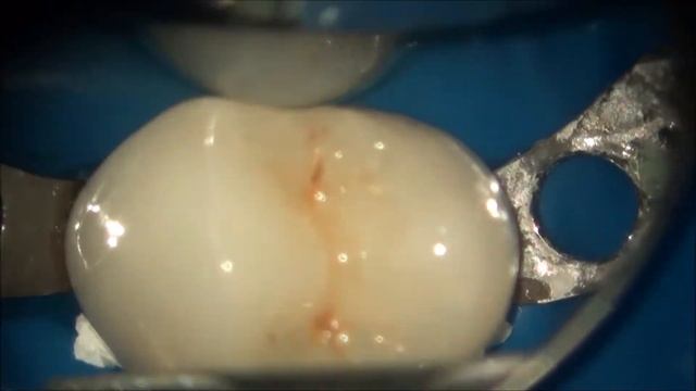 Изоляция зуба перед фиксацией керамической реставрации смотреть онлайн