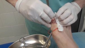 Вросший ноготь. Оперирует доктор Ельшанский И В