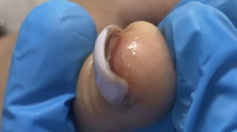 Сорванный ноготь