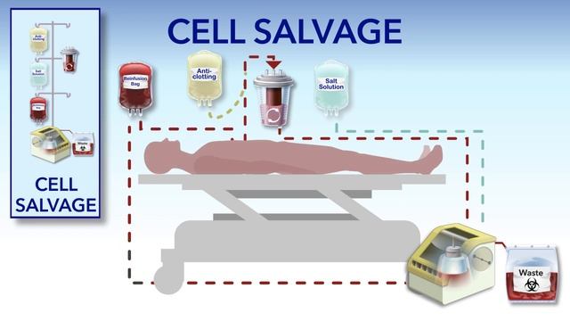 Cell Salvage and Hemodilution смотреть онлайн