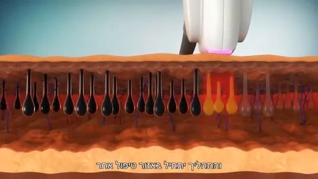 Hyper Pulse ALT - טיפולי הסרת שיער אולטרה מהירים וטיפולי מרקם העור смотреть онлайн