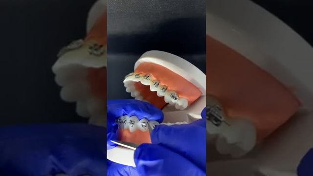 Що робити, якщо ви відклеїли самолігуючий брекет (Брекет на замку) смотреть онлайн