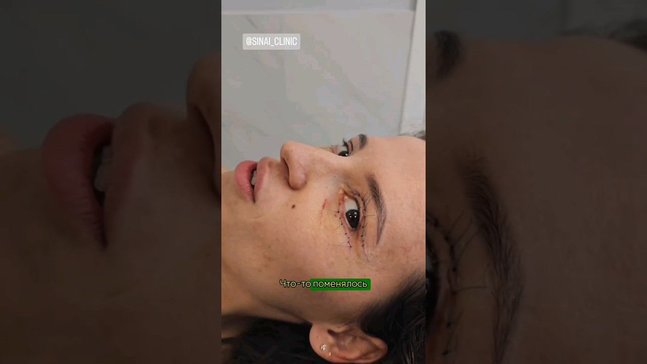 НЕ УЗНАЛА СЕБЯ ПОСЛЕ ОПЕРАЦИИ      #пластическийхирург #пластика