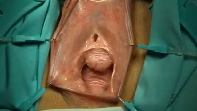 Komyakov technique of the transposition of female urethra смотреть онлайн