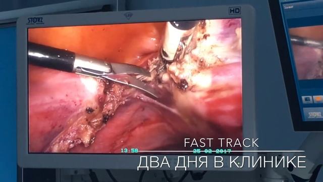 Лапароскопическая ампутация матки в клинике "Здоровая Нация" (г.Махачкала) смотреть онлайн