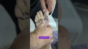 Массаж стоп при вальгусе(шишке) на ногах