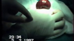 Ущемлённая грыжа белой линии живота