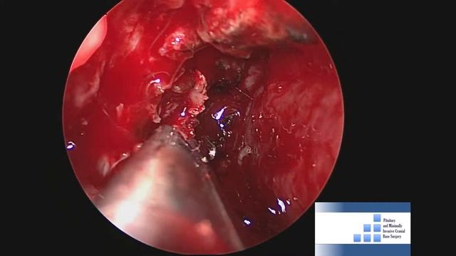 Endoscopic endonasal ligation of the sphenopalatine artery (SPA) смотреть онлайн