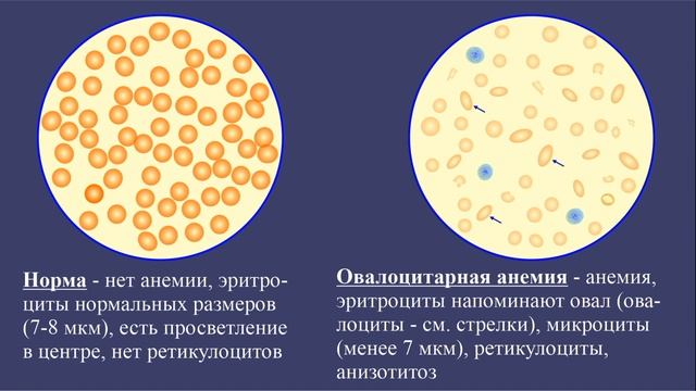 Тема 37.3. Анемии. Клиническая и лабораторная диагностика смотреть онлайн
