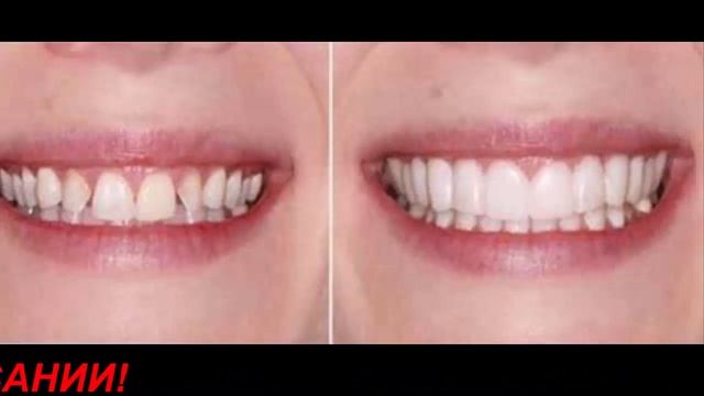 Как поставить зубной винир, установка виниров дома, как ставить правильно и где купить виниры смотреть онлайн