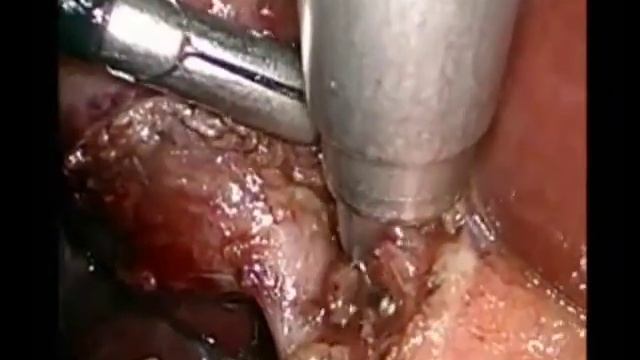 Острый холецистит .LAPAROSCOPY   AND   ACUTE   CHOLECYSTITIS