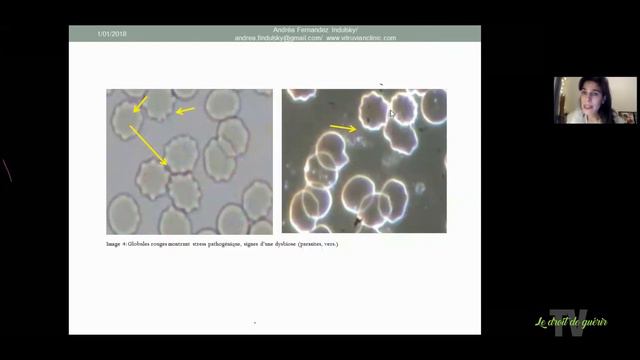 Maladie de Lyme - Webinaire du 9 mars 2018 avec Andréa смотреть онлайн