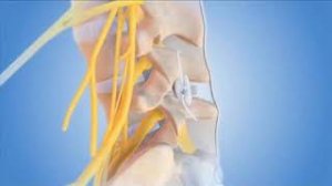 DIAM межостистый фиксатор, для профилактики боли в спине после микродискэктомии