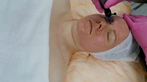 Фракционная мезотерапия, этапы. Что такое Дермапен?