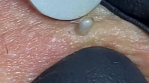 Relax Every Day ?Самое залипательное видео давить прыщи Dermatologist.video to press pimples АКНЕ