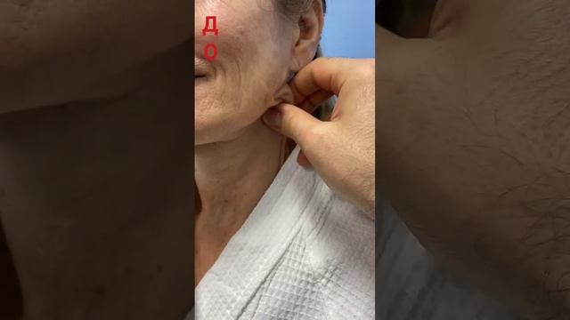 Подтяжка лица и шеи со smas лифтингом. смотреть онлайн
