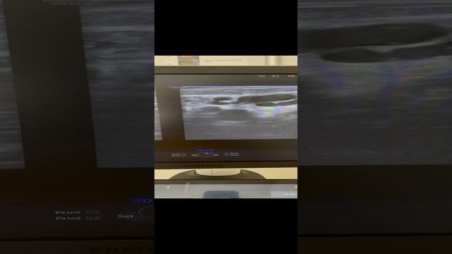 Тазовый варикоз у беременной. Узи сосудов малого таза. Флеболог Москва смотреть онлайн