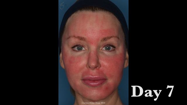 Dr. Obagi Blue Peel | Amazing Before and After Results | Anti-Aging Skincare Over 40 смотреть онлайн