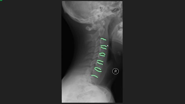РЕНТГЕН-АНАТОМИЯ ШЕЙНОГО ОТДЕЛА ПОЗВОНОЧНИКА смотреть онлайн