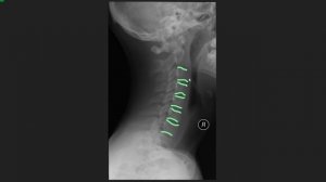 РЕНТГЕН-АНАТОМИЯ ШЕЙНОГО ОТДЕЛА ПОЗВОНОЧНИКА
