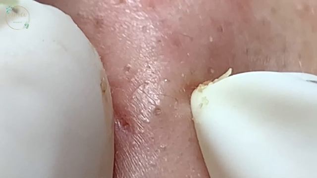 Treatment Of Blackheads And Hidden Acne #057 смотреть онлайн