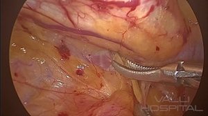 Laparoscopic TAPP Inguinal Hernia Surgery - Dissection Technique