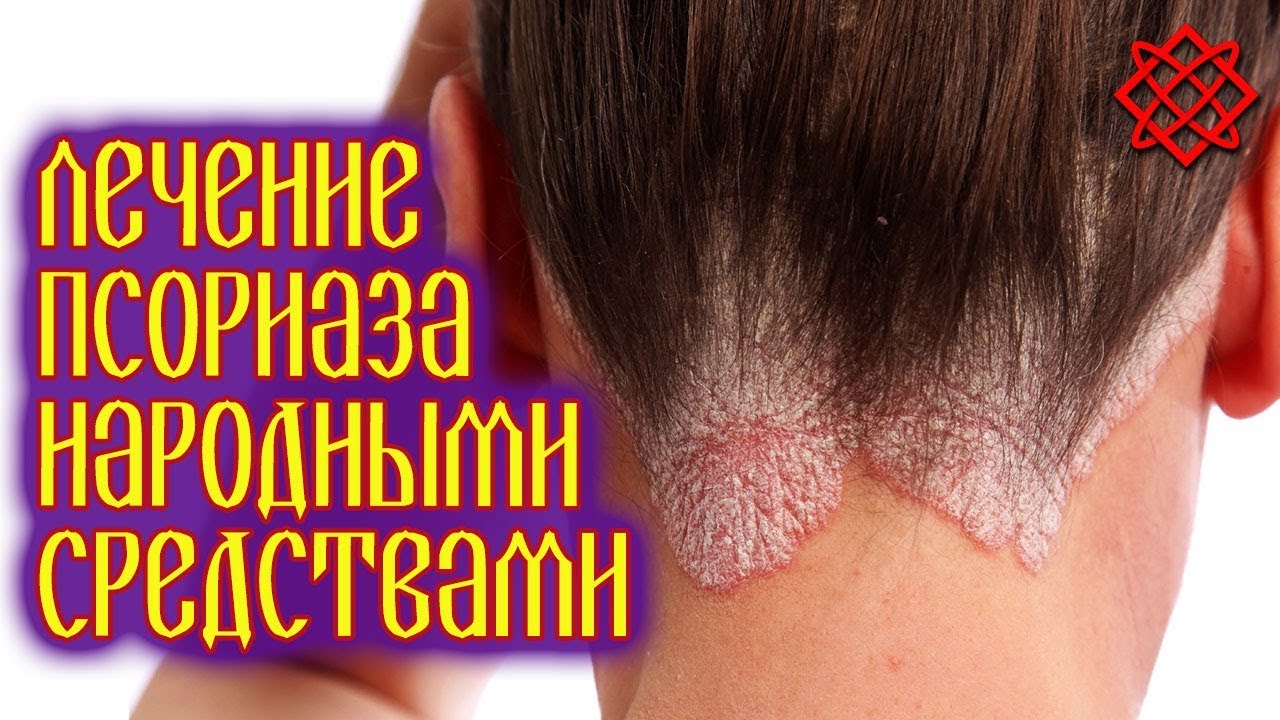 ЛЕЧЕНИЕ ПСОРИАЗА В ДОМАШНИХ УСЛОВИЯХ. Как Вылечить Псориаз Легко и Быстро.mp4