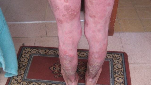 PSORIASIS TESTIMONIO GANO EXCEL смотреть онлайн