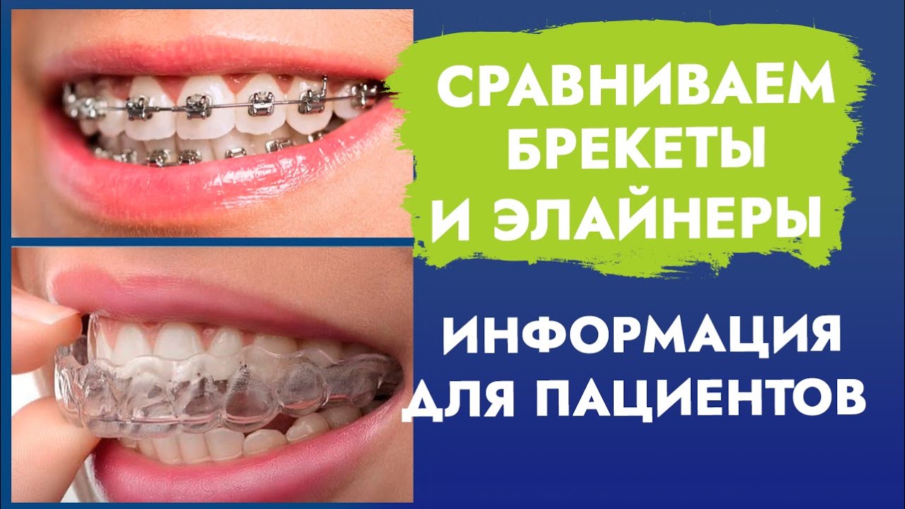 Сравниваем Брекеты и Элайнеры. Информация для пациентов. смотреть онлайн