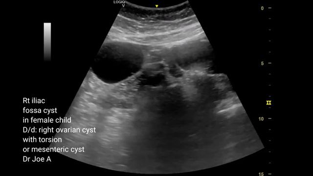 Right iliac fossa cyst in young girl. ? right ovarian cyst mesenteric cyst ultrasound video. смотреть онлайн