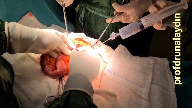 KÜÇÜK DOKUNUŞLAR HAYAT KURTARIR BİRİD İLEUS AMELİYATI Profdrunalaydın