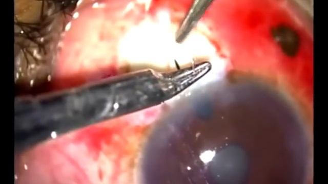 Трабекулэктомия с 5-фторурацилом (Trabeculectomy With 5-FU)