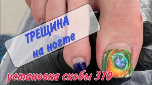 📌БОЛИТ палец _ 💥мозоли под ногтем _ 👩_⚕️подология _ 🔱скоба для ногтей