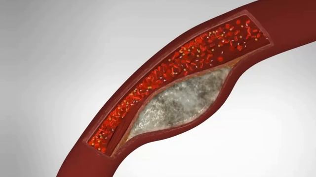 The Difference Between Cardiac Arrest, Heart Attack, and Heart Failure - 3D Animation смотреть онлайн