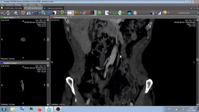 АОРТА , АСБ . смотреть онлайн