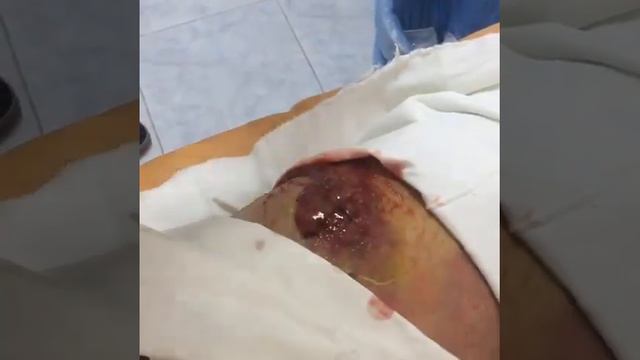 вскрытие карбункула в Махачкале