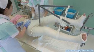 What Happened to Mary?!  ? She gets Hip Spica and Long Leg Plaster Casts!