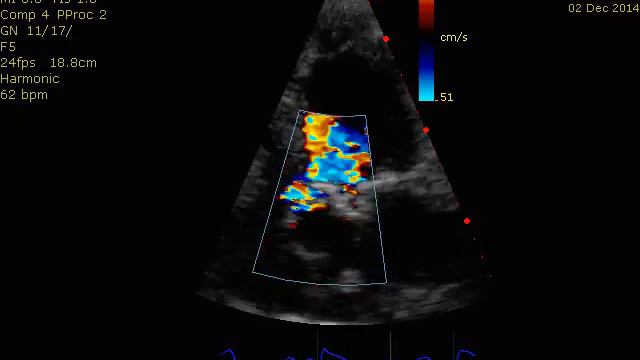 aortic insufficiency смотреть онлайн