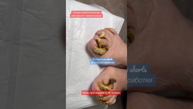 Онихогрифоз / грибок ногтей / медицинский педикюр / педикюр на дом #подологмосква смотреть онлайн
