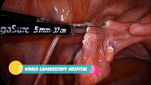 Skin to Skin Total Laparoscopic Hysterectomy with Infrared Ureteric Stent смотреть онлайн