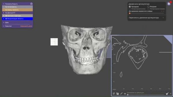 Exocad-Цифровой вариатор / Digital Variator for Exocad
