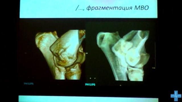 Слепые пятна рентгенографии смотреть онлайн