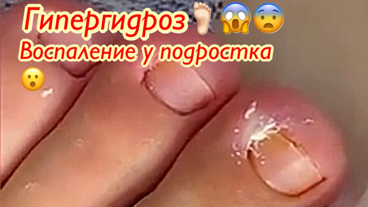 Воспаление у подростка при гипергидрозе??❗️☝? смотреть онлайн