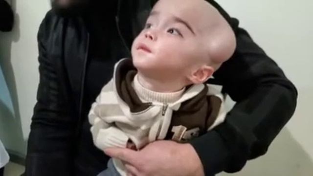 ГИДРОАЭНЦЕФАЛИЯ.ПОЛНОЕ ОТСУТСТВИЕ МОЗГА. КИСТОЗНО РУБЦОВЫЕ ДЕГЕНЕРАЦИИ БОЛЬШИХ ПОЛУШАРИЙ. смотреть онлайн