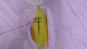 обвивной шов взахлест или Ревердена - Мультановского (техника; как наложить)