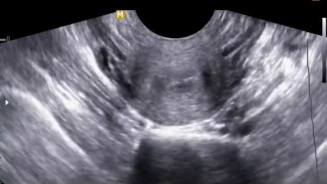 Несостоятельный рубец после кесарева сечения смотреть онлайн