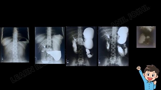 SPOTTERS FROM X-RAY PROCEDURES (BARIUM UPPER G.I.T.- 100)BY DR . ANIL JOSHI(PROFESSOR OF RADIOLOGY) смотреть онлайн