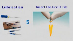 Эндодонтия.Техника Step-back.