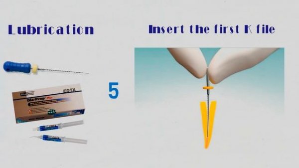 Эндодонтия.Техника Step-back.