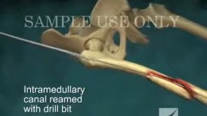 Интрамедуллярный остеосинтез перелома правой бедренной кости